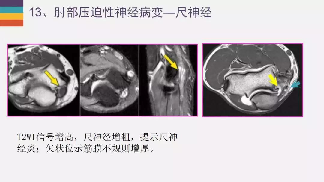 【PPT】肘关节常见病变MR诊断