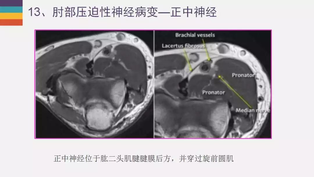 【PPT】肘关节常见病变MR诊断