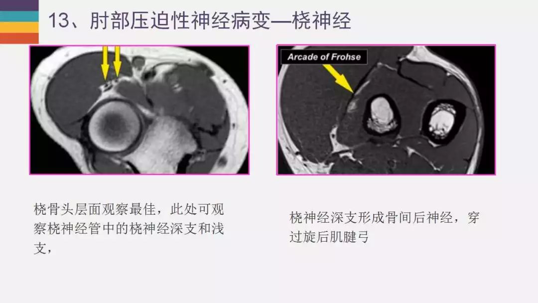 【PPT】肘关节常见病变MR诊断