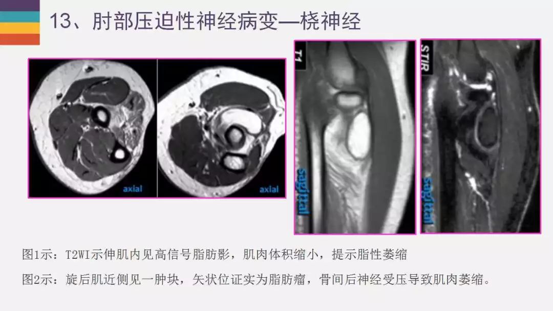 【PPT】肘关节常见病变MR诊断