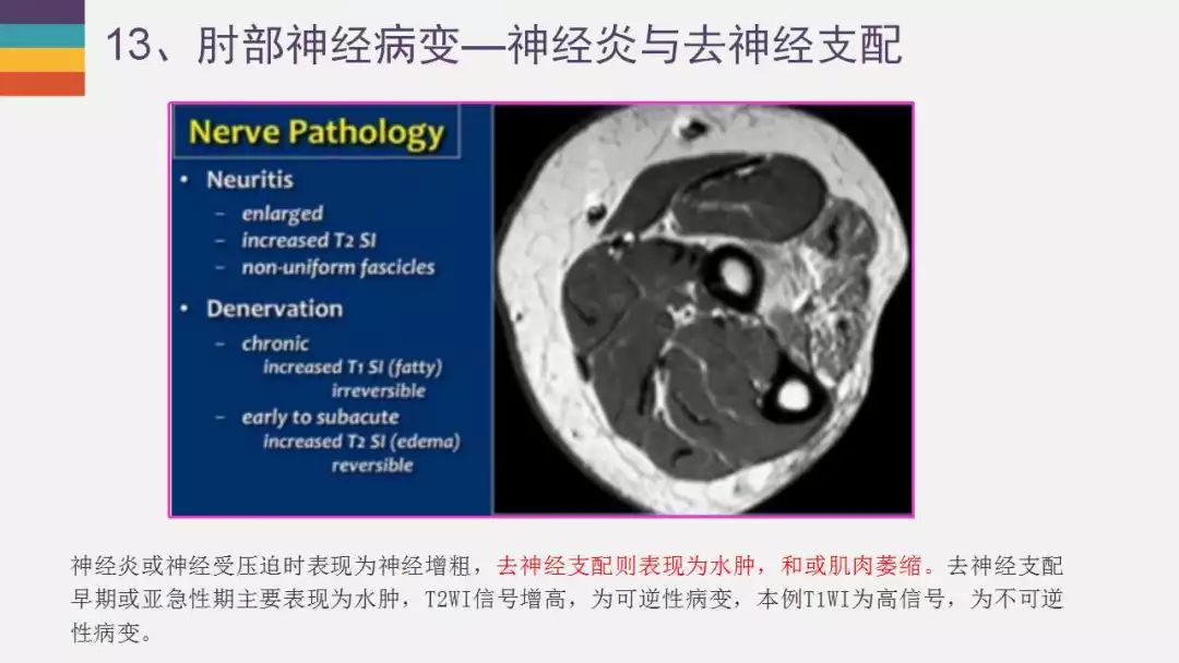 【PPT】肘关节常见病变MR诊断