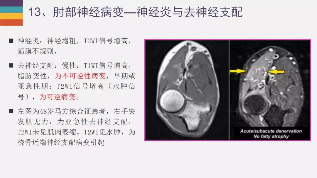 【PPT】肘关节常见病变MR诊断