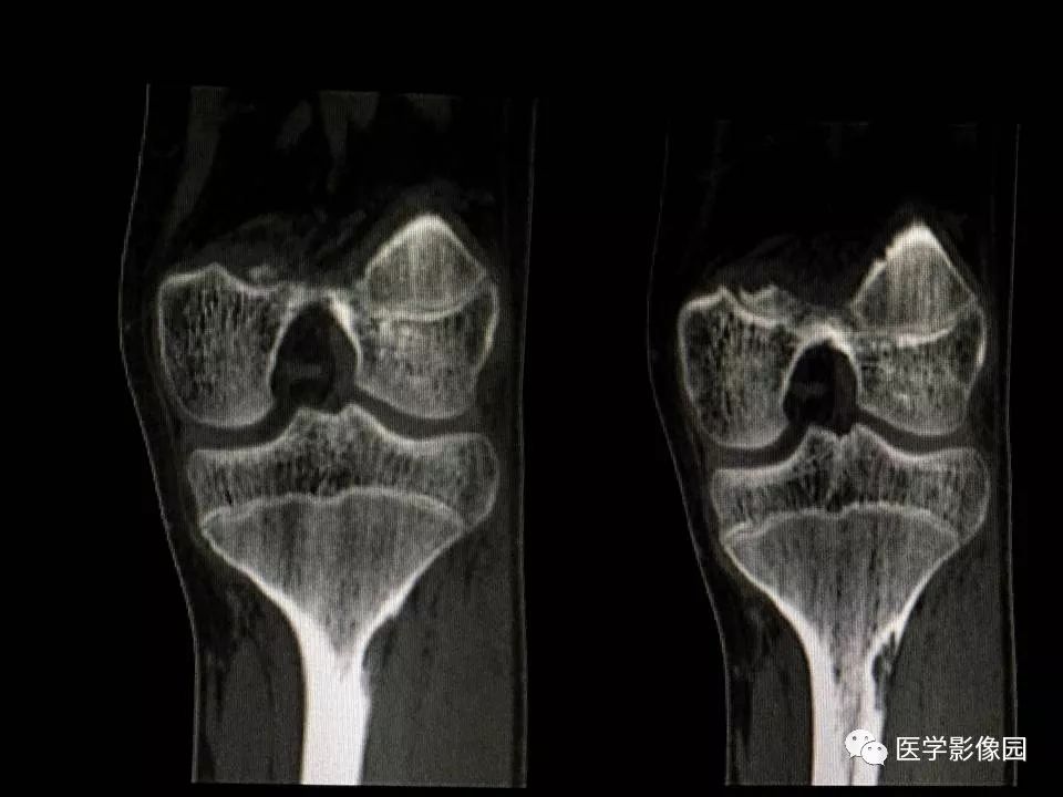 【病例】胫骨纤维性骨皮质缺损1例CT影像表现