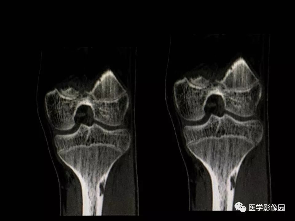 【病例】胫骨纤维性骨皮质缺损1例CT影像表现
