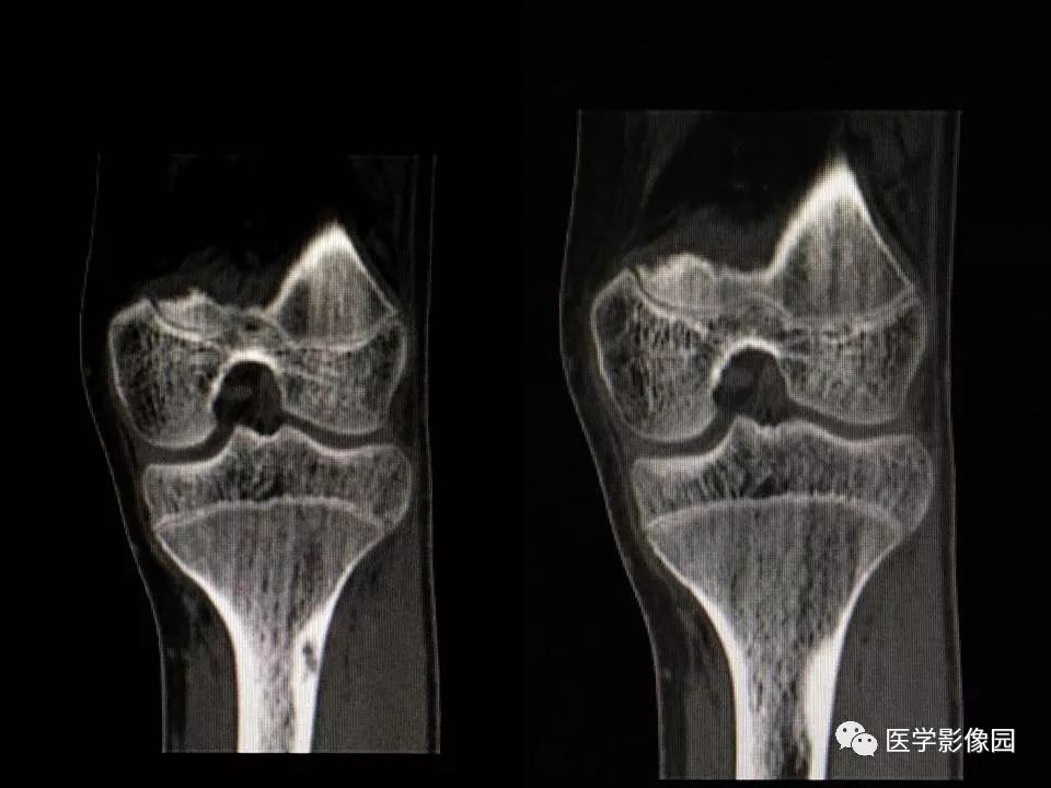 【病例】胫骨纤维性骨皮质缺损1例CT影像表现