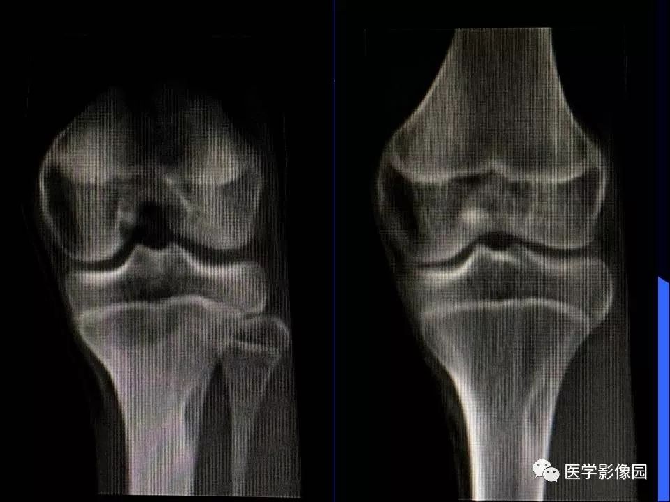 【病例】胫骨纤维性骨皮质缺损1例CT影像表现