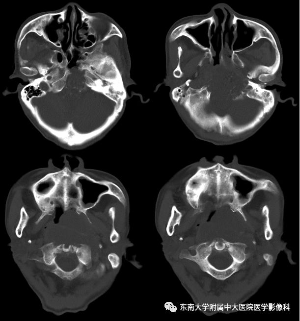 【病例】颅底脊索瘤1例CT及MR影像表现