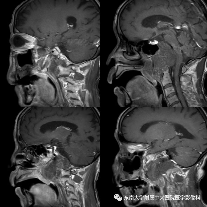 【病例】颅底脊索瘤1例CT及MR影像表现