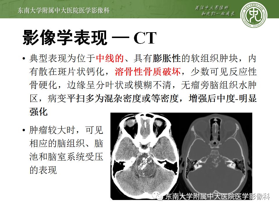 【病例】颅底脊索瘤1例CT及MR影像表现