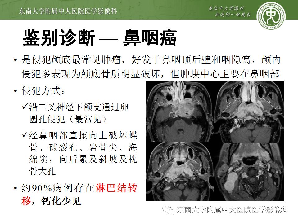 【病例】颅底脊索瘤1例CT及MR影像表现