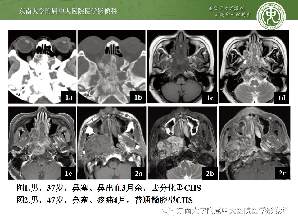 【病例】颅底脊索瘤1例CT及MR影像表现