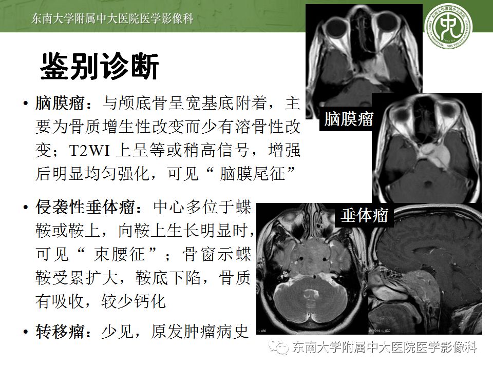 【病例】颅底脊索瘤1例CT及MR影像表现