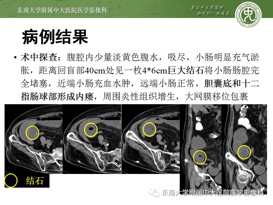 【病例】胆肠瘘并胆石性肠梗阻1例CT影像表现