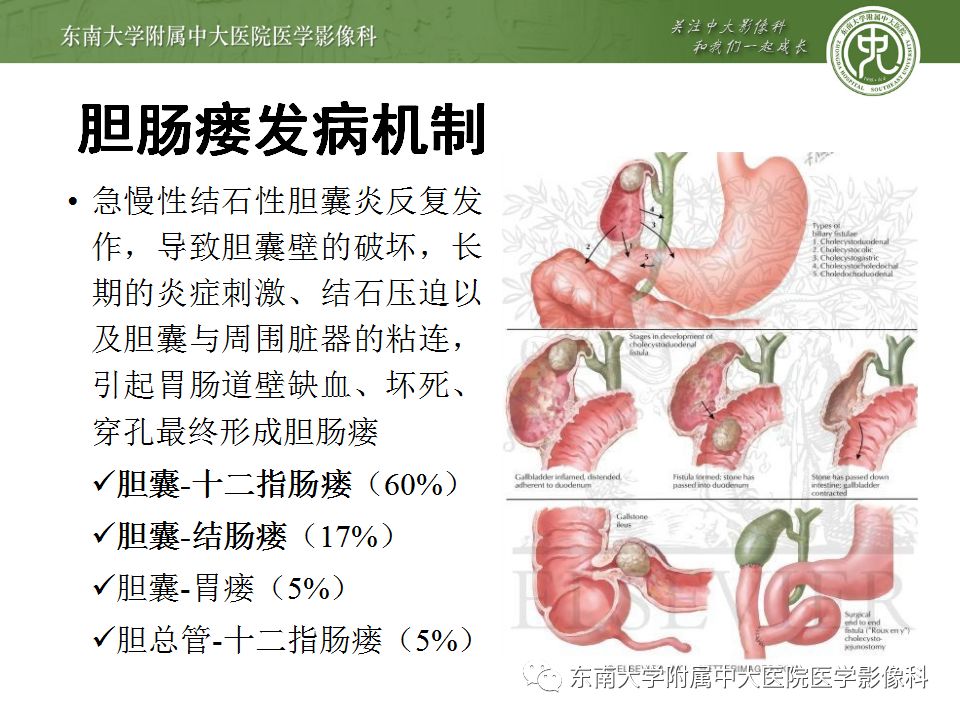 【病例】胆肠瘘并胆石性肠梗阻1例CT影像表现