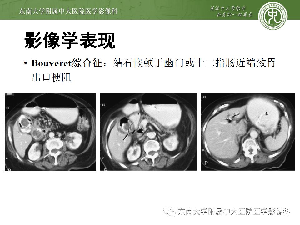 【病例】胆肠瘘并胆石性肠梗阻1例CT影像表现