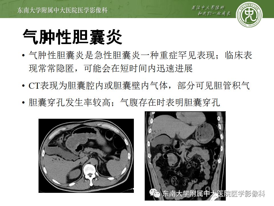 【病例】胆肠瘘并胆石性肠梗阻1例CT影像表现