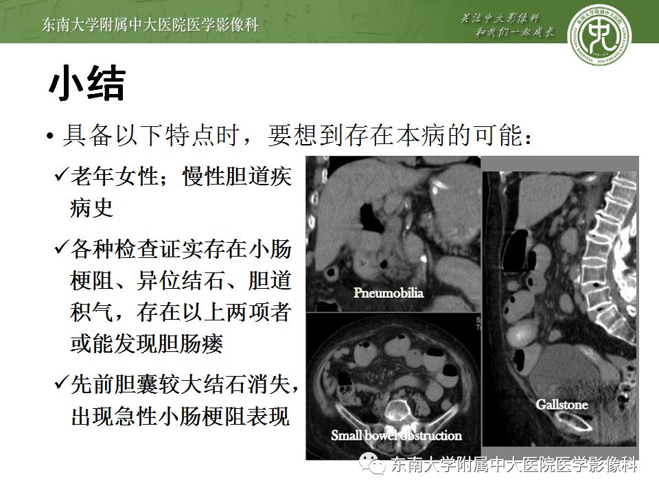 【病例】胆肠瘘并胆石性肠梗阻1例CT影像表现