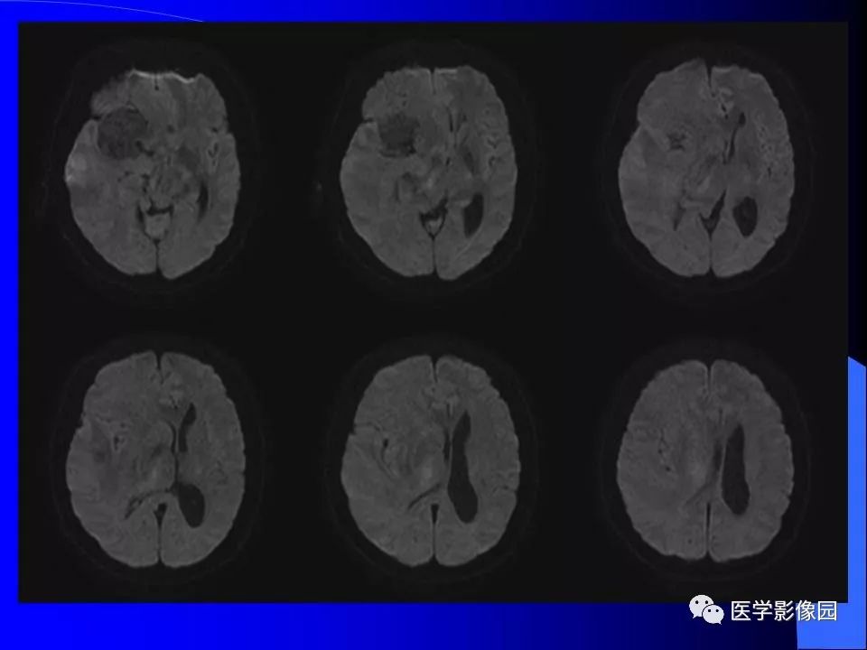 【病例】颅内血管外皮细胞瘤1例CT及MR影像表现