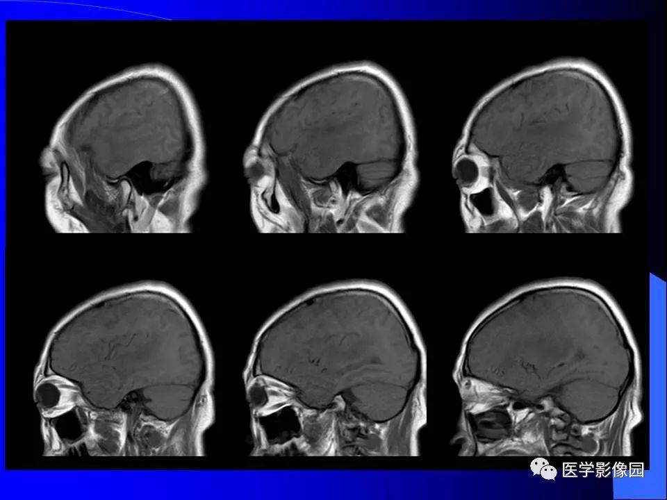 【病例】颅内血管外皮细胞瘤1例CT及MR影像表现