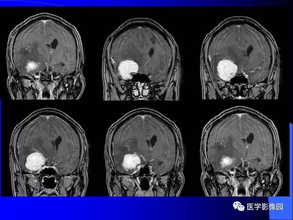 【病例】颅内血管外皮细胞瘤1例CT及MR影像表现