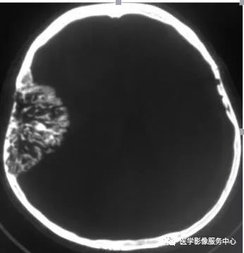 【典型病例】颅骨海绵状血管瘤1例CT及MR影像表现