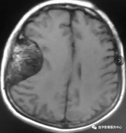 【典型病例】颅骨海绵状血管瘤1例CT及MR影像表现 【典型病例】颅骨海绵状血管瘤1例CT及MR影像表现