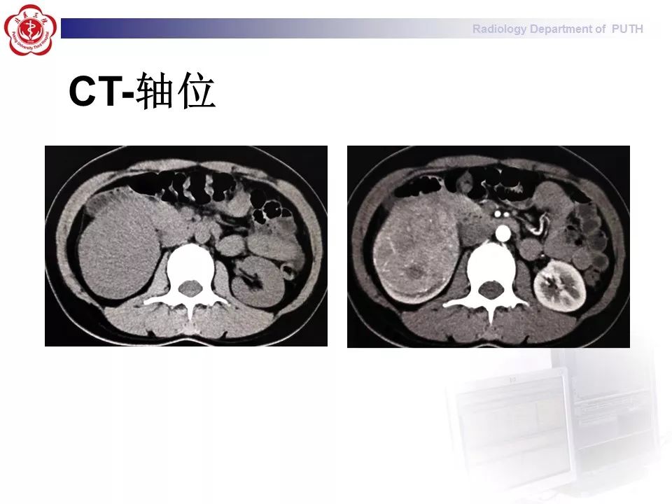 【病例】 肾脏嫌色细胞癌1例CT及MR影像表现