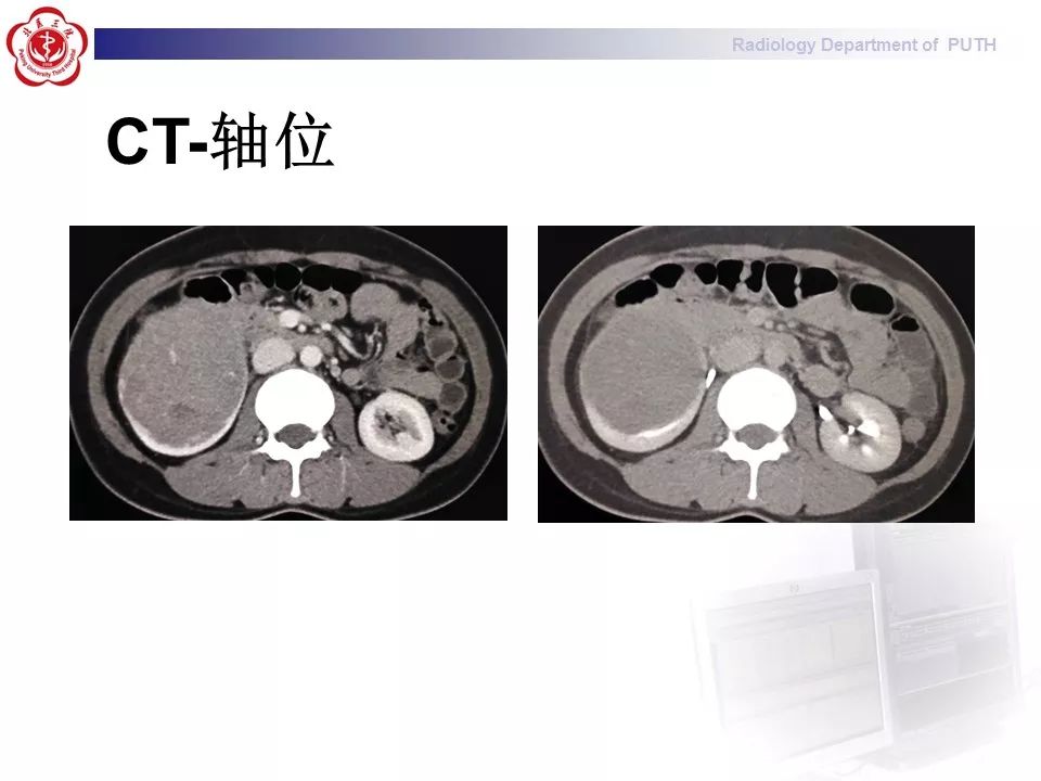 【病例】 肾脏嫌色细胞癌1例CT及MR影像表现