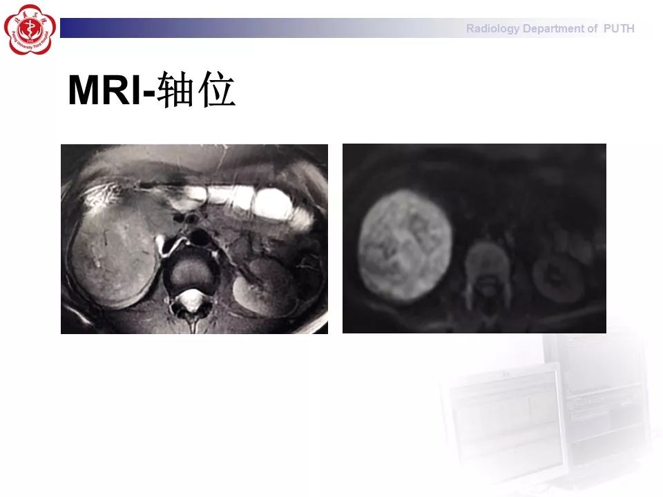 【病例】 肾脏嫌色细胞癌1例CT及MR影像表现