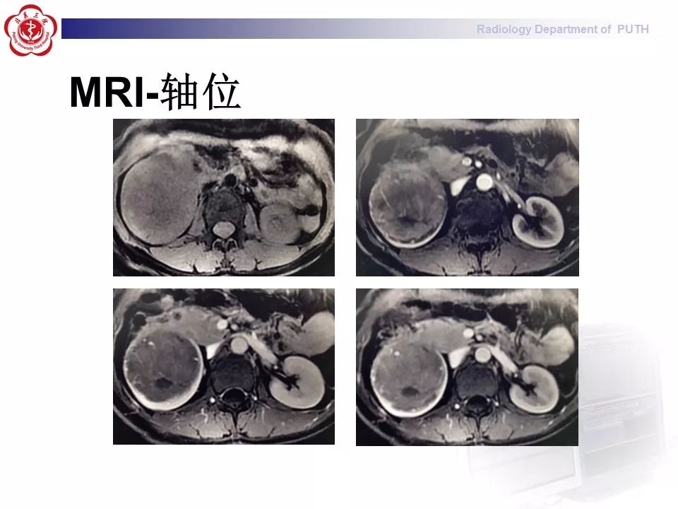 【病例】 肾脏嫌色细胞癌1例CT及MR影像表现