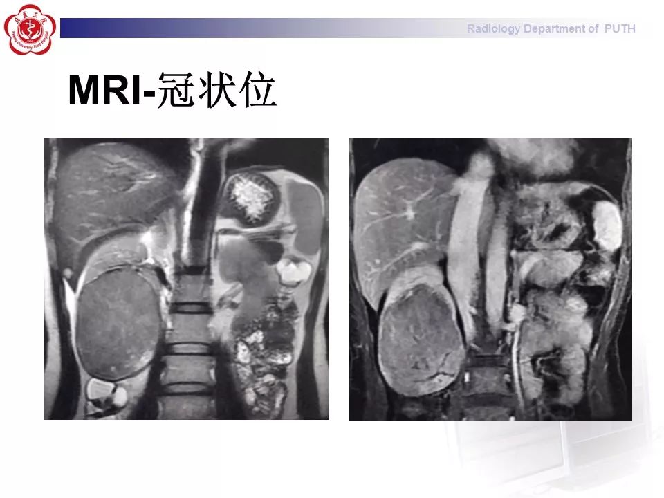 【病例】 肾脏嫌色细胞癌1例CT及MR影像表现