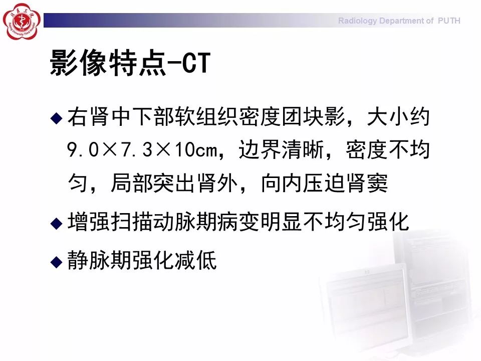 【病例】 肾脏嫌色细胞癌1例CT及MR影像表现