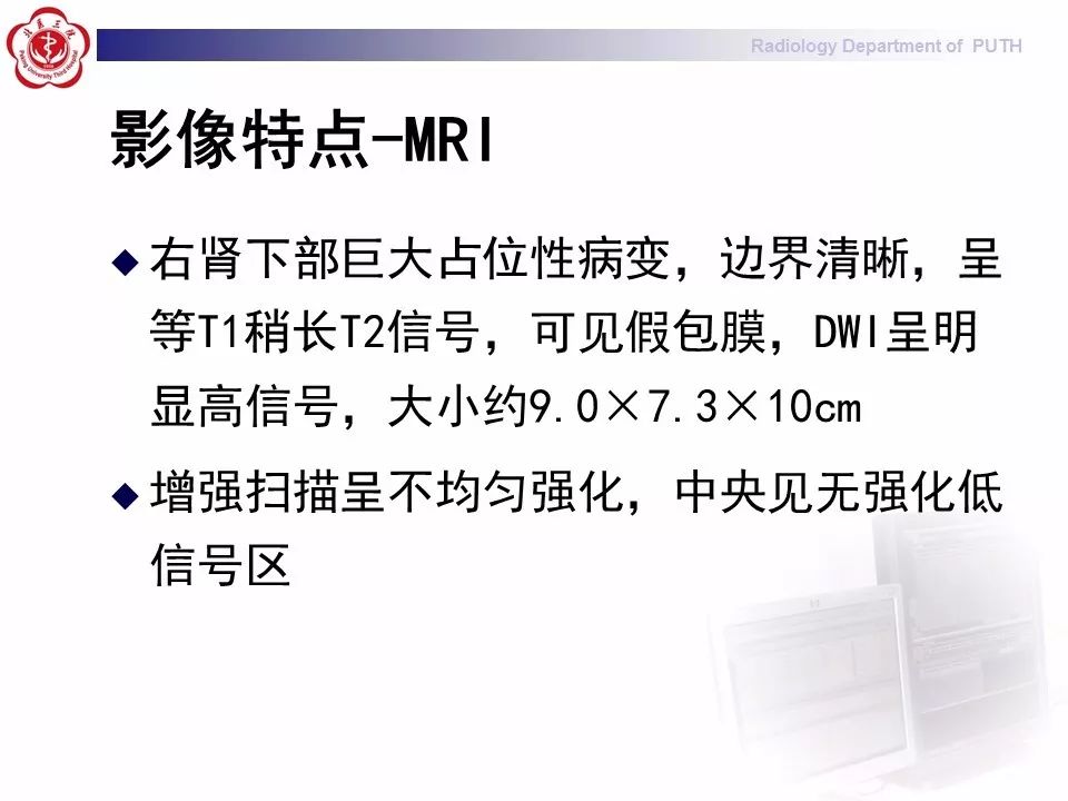 【病例】 肾脏嫌色细胞癌1例CT及MR影像表现