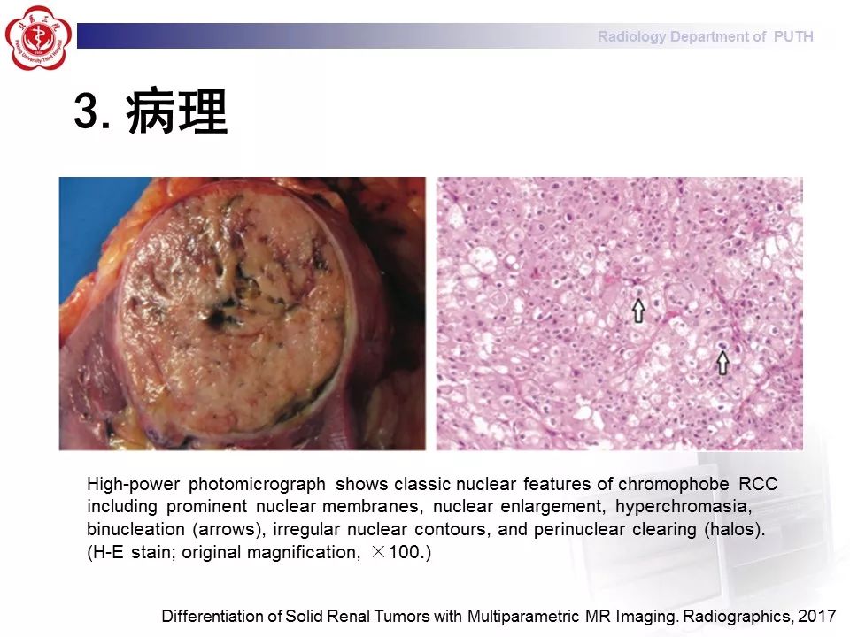 【病例】 肾脏嫌色细胞癌1例CT及MR影像表现