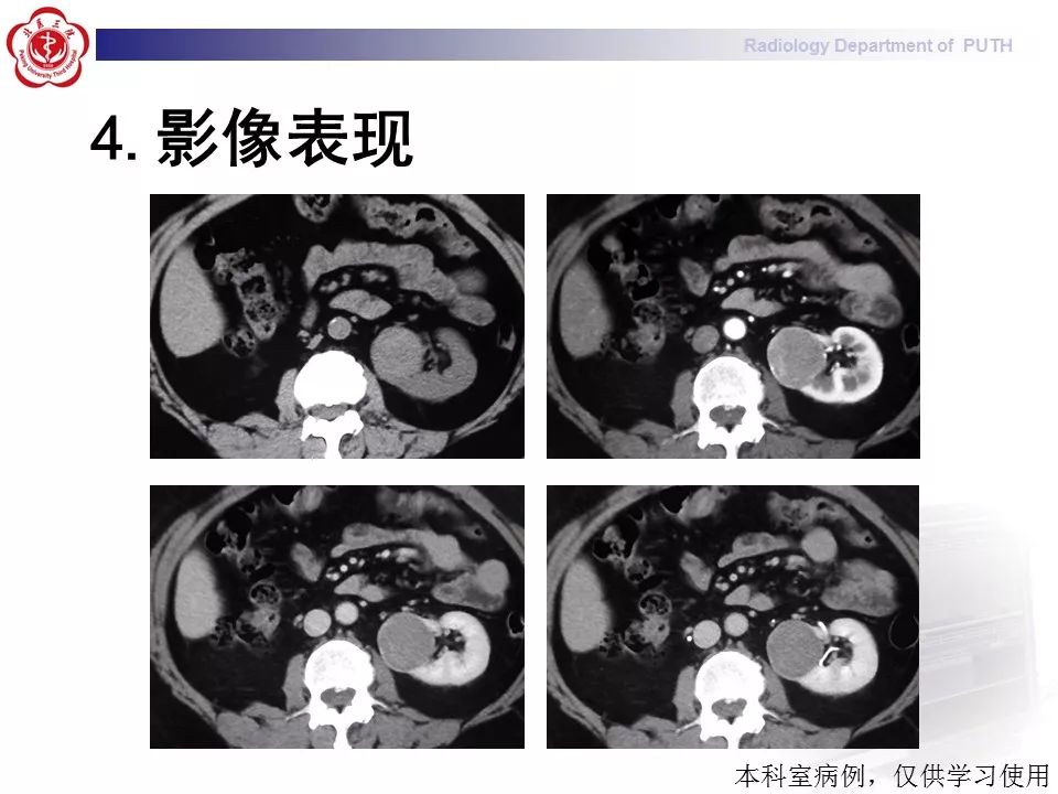 【病例】 肾脏嫌色细胞癌1例CT及MR影像表现