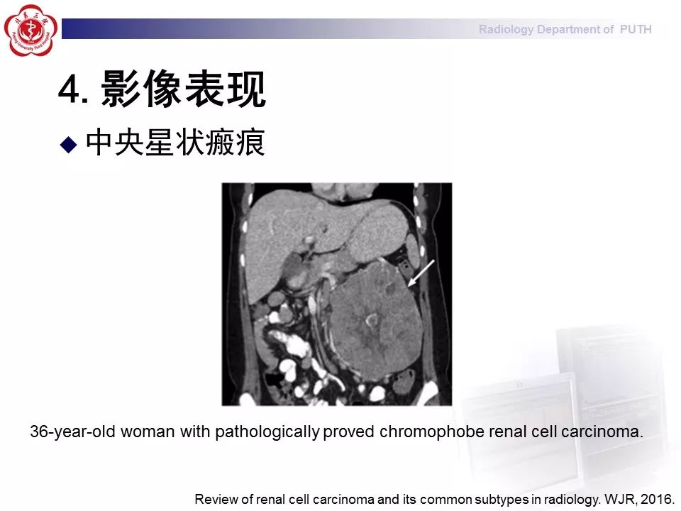 【病例】 肾脏嫌色细胞癌1例CT及MR影像表现