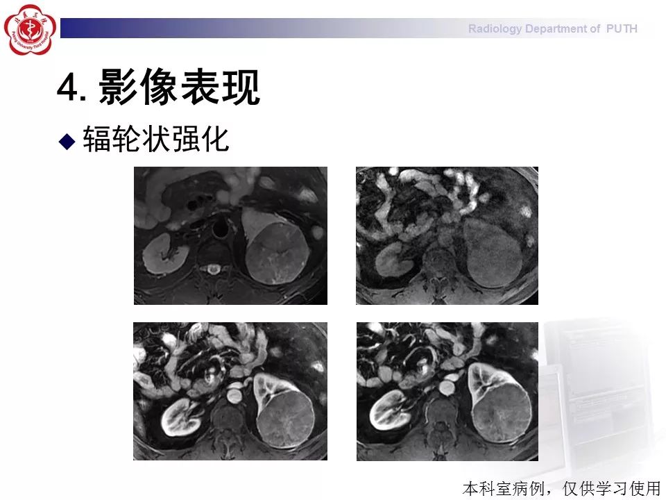 【病例】 肾脏嫌色细胞癌1例CT及MR影像表现