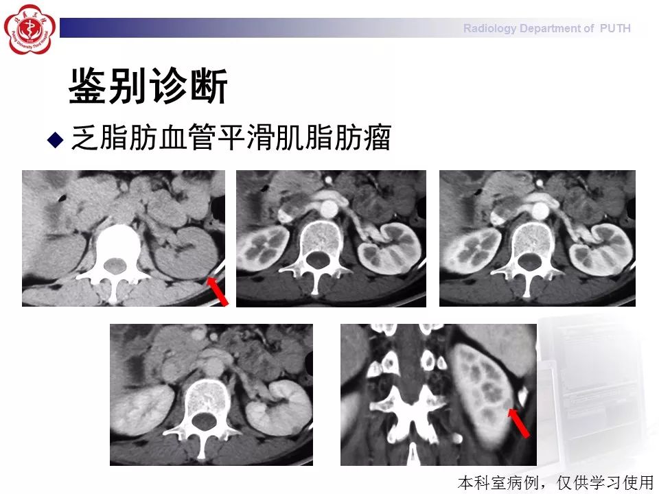 【病例】 肾脏嫌色细胞癌1例CT及MR影像表现