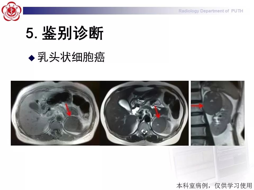 【病例】 肾脏嫌色细胞癌1例CT及MR影像表现
