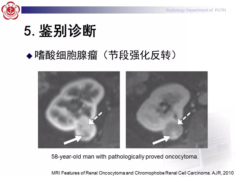 【病例】 肾脏嫌色细胞癌1例CT及MR影像表现