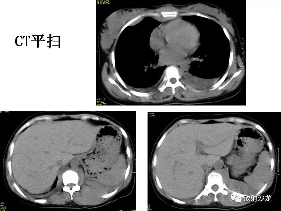 【病例】胸壁粒细胞肉瘤1例CT影像表现
