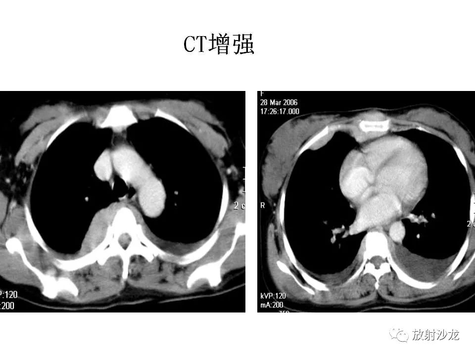 【病例】胸壁粒细胞肉瘤1例CT影像表现