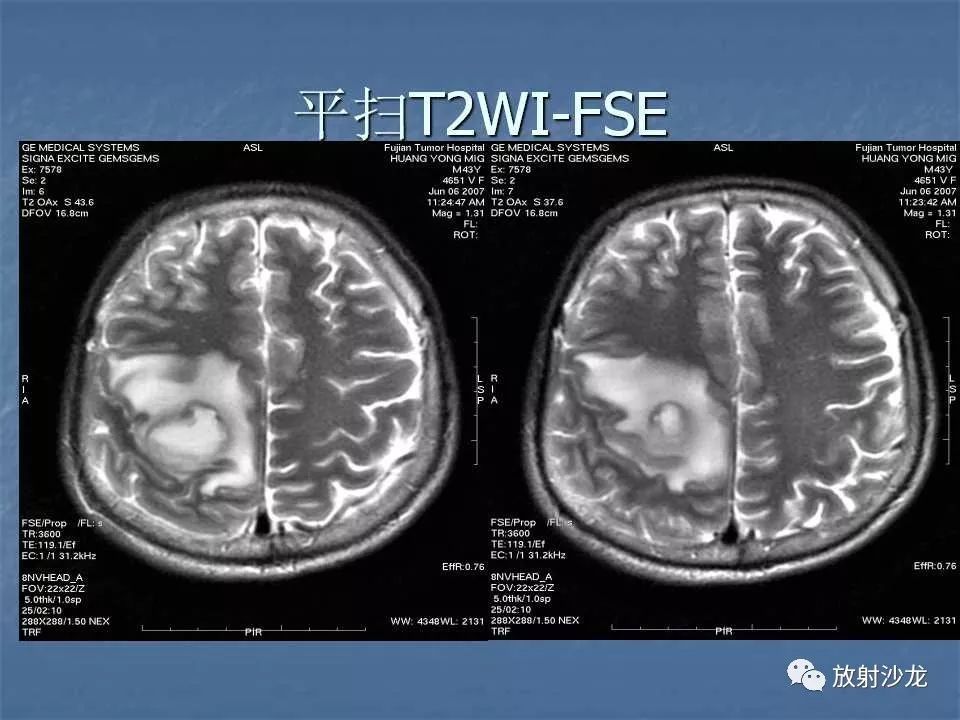 【病例】右顶叶炎性肉芽肿1例MR