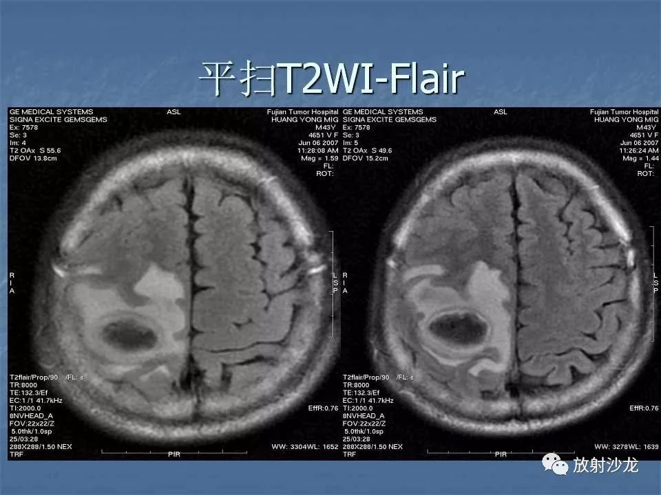 【病例】右顶叶炎性肉芽肿1例MR