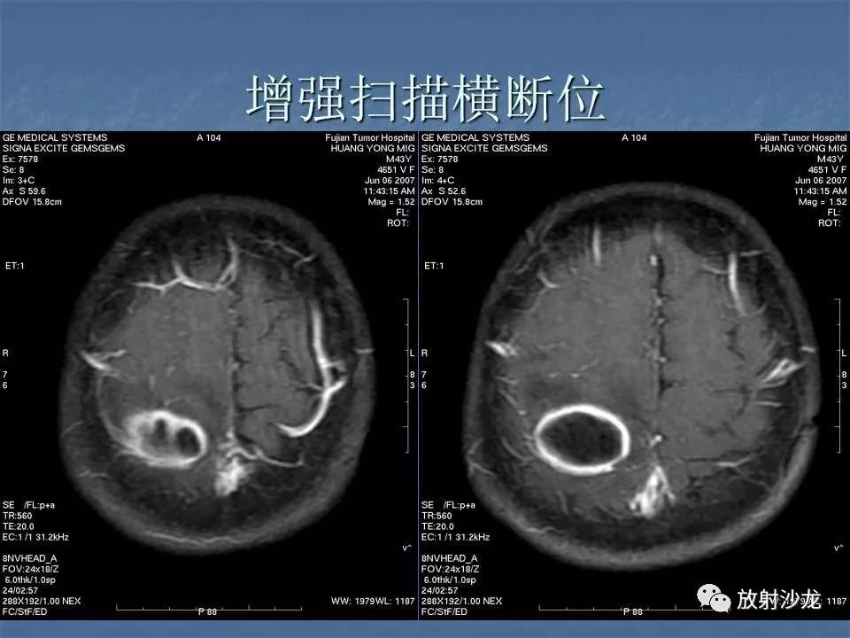 【病例】右顶叶炎性肉芽肿1例MR