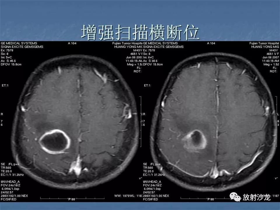 【病例】右顶叶炎性肉芽肿1例MR