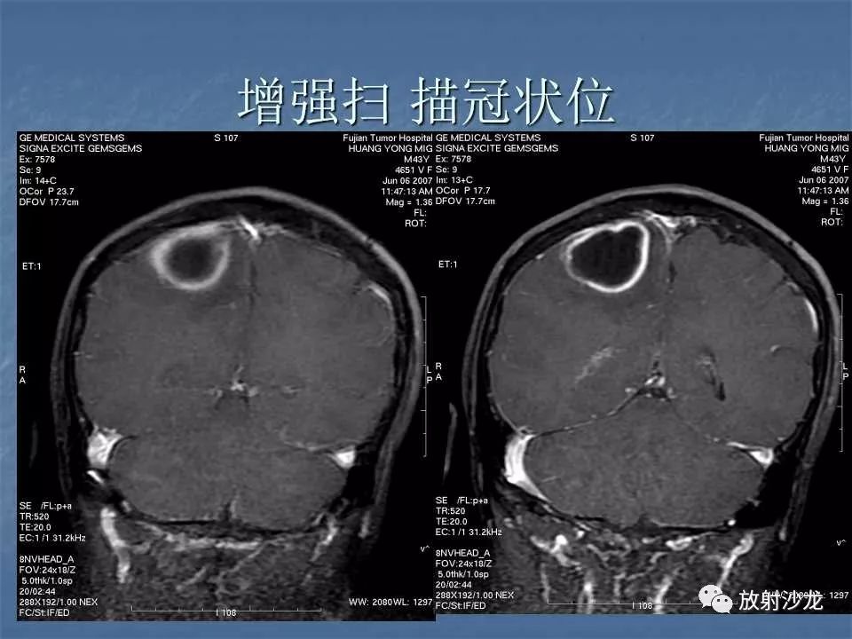 【病例】右顶叶炎性肉芽肿1例MR
