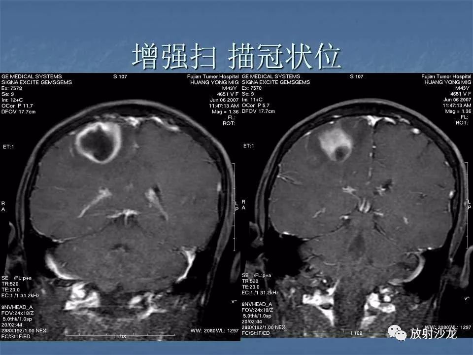 【病例】右顶叶炎性肉芽肿1例MR