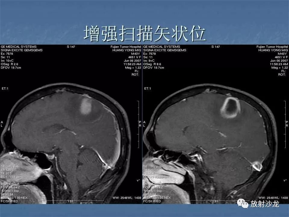 【病例】右顶叶炎性肉芽肿1例MR