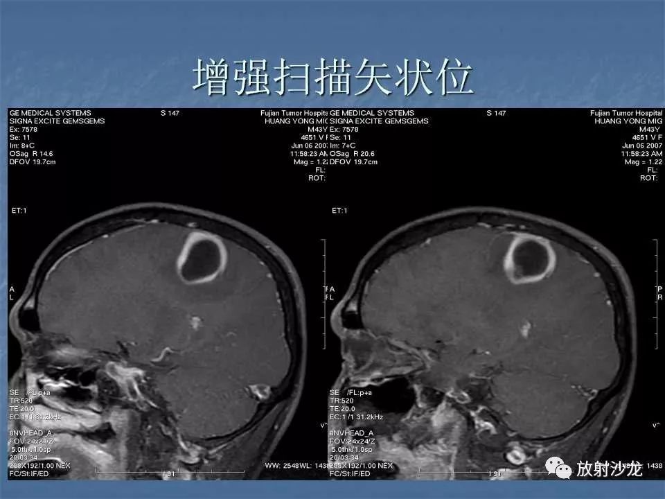 【病例】右顶叶炎性肉芽肿1例MR
